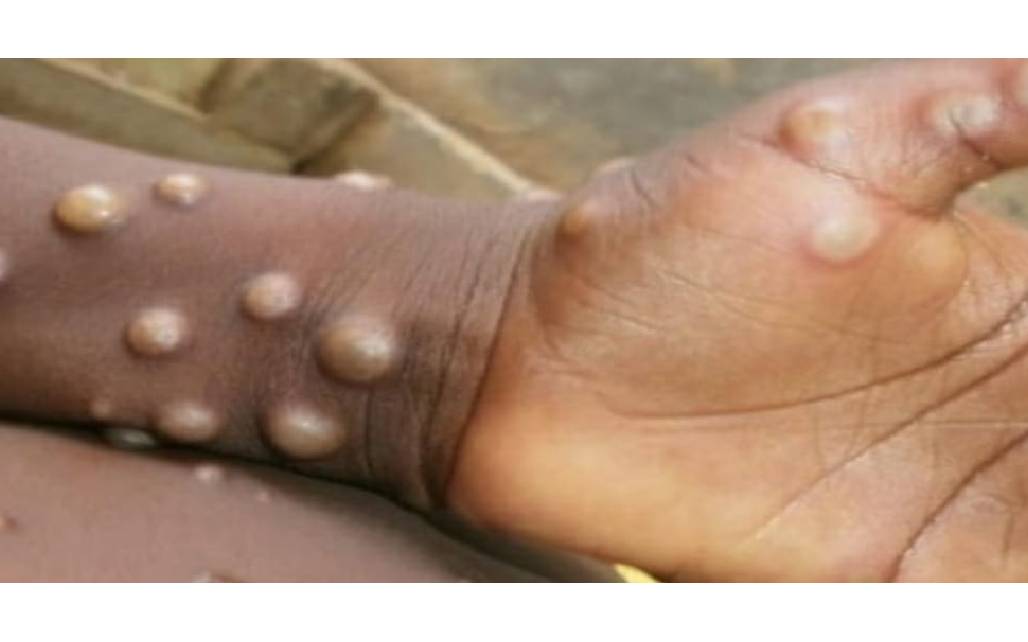 विश्व स्वास्थ्य संगठन (WHO)  द्वारा मंकीपॉक्स वायरस को लेकर “ग्लोबल हेल्थ इमरजेंसी” घोषित करने के बाद, भारत में अलर्ट जारी किया गया है। भारत ..