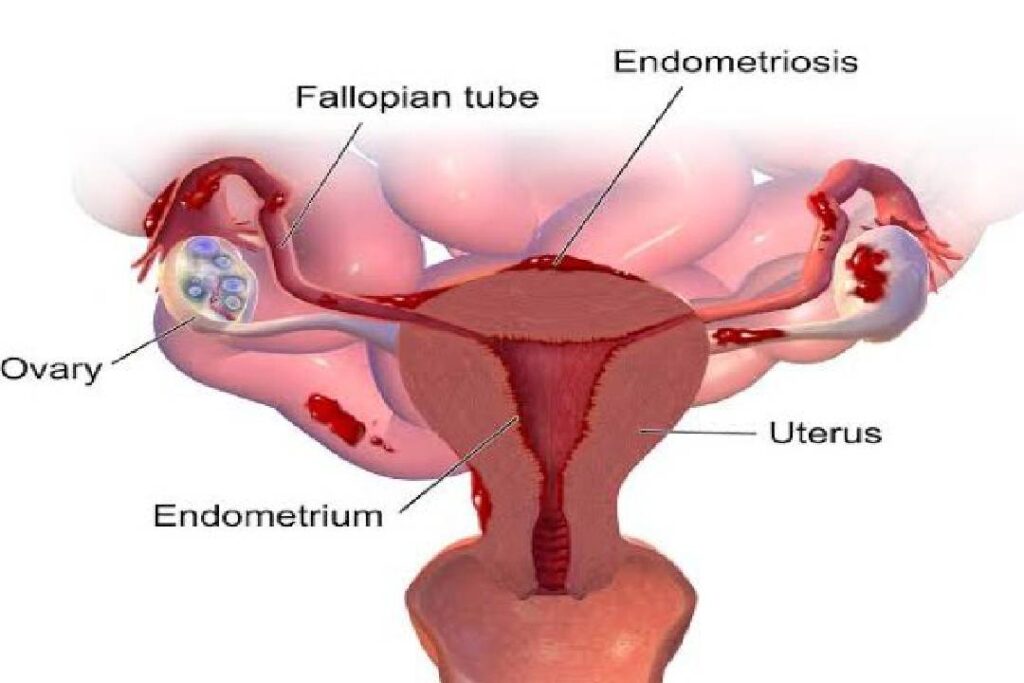 एंडोमेट्रियोसिस एक महलाओं की एक ऐसी बीमारी है जिसमें गर्भाशय की परत के समान ऊतक गर्भाशय के बाहर बढ़ने लगते हैं। इसे घातक इसलिए माना जाता ह...